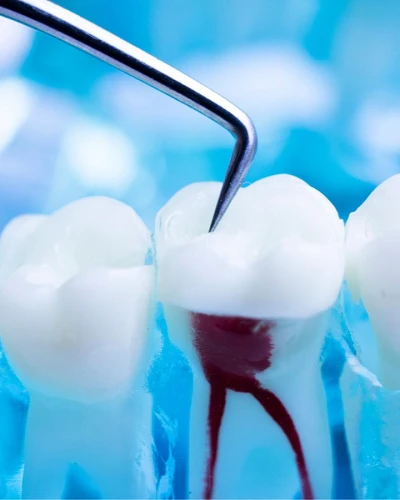 Endodoncia