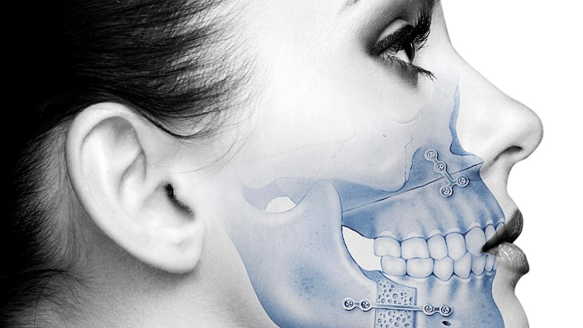 Surgical Orthodontic Planning