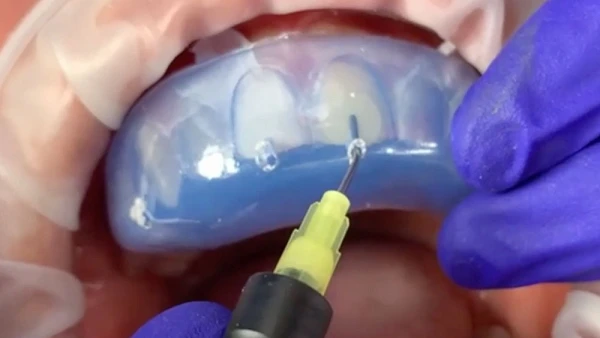 Injected Resin Veneers